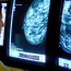 Breast cancer screening