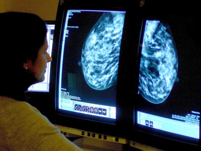 2-72357887 Breast cancer