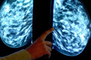 ‘AI may be able to safely assess breast cancer scans’