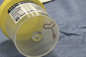Surgeon probing Australian woman’s mystery symptoms finds live worm in her brain