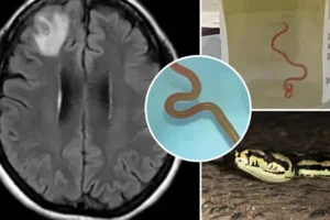 Parasitic 8cm-long worm found ‘alive and wriggling’ in woman’s brain after months of ‘depression and forgetfulness’