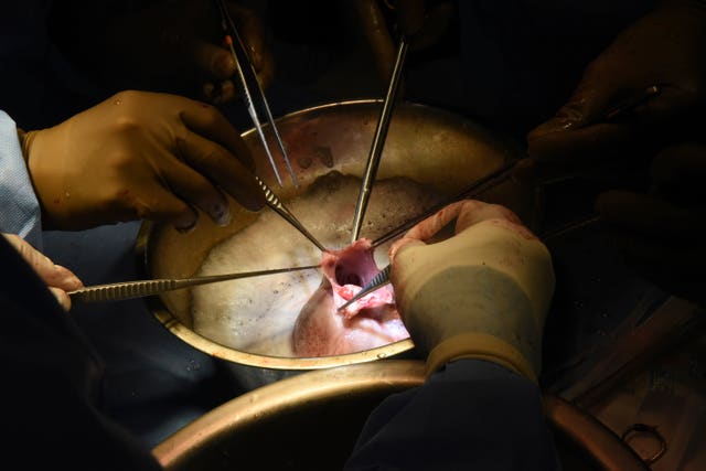 12c74a707f0e40e7a566cf2548432d13 CORRECTION Pig Heart Transplant