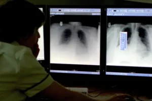 Computer modelling ‘could simplify lung cancer screening’