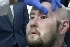 Surgeons perform world’s first eye transplant on man who suffered electric shock