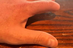 McCain Foods fined £700,000 after worker needs fingers amputated after accident