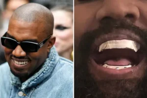 Kanye West has teeth removed and ‘replaced’ with $850,000 titanium dentures