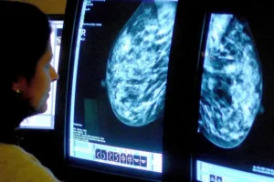 AI tool that predicts side-effect risk in breast cancer patients to be trialled