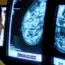 Breast cancer screening